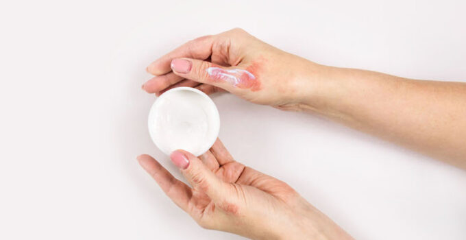 How to Choose the Perfect Solution for Your Skin: A Guide to Finding the Ideal Eczema Cream