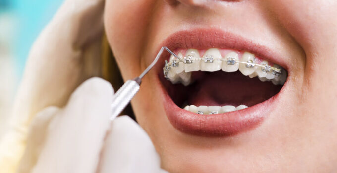 Orthodontics for a Lifetime: Long-Term Benefits and Retention Strategies
